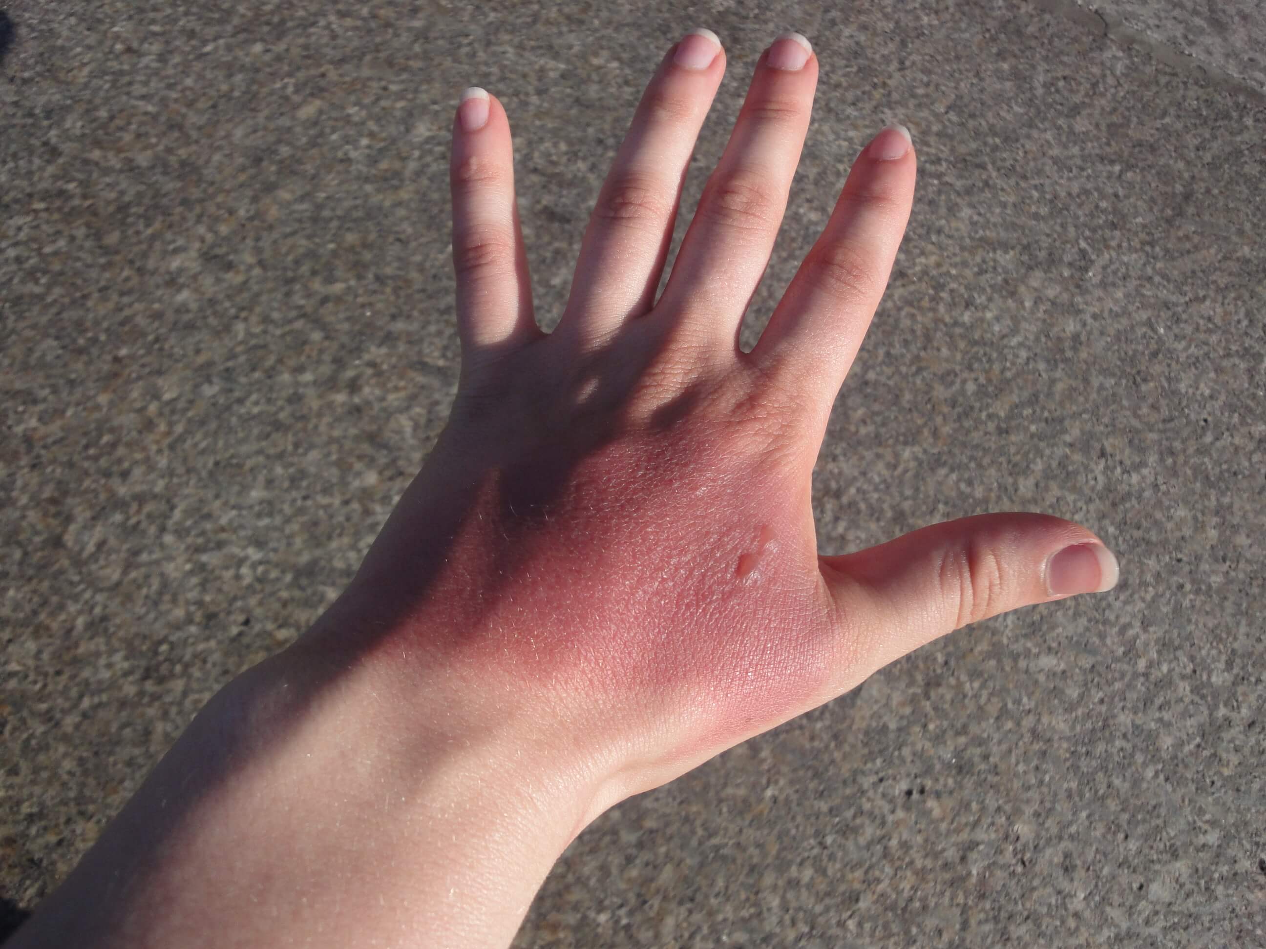 Queimadura - O que fazer?