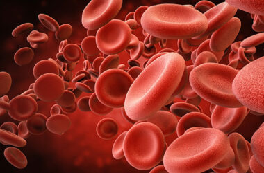 Anemia